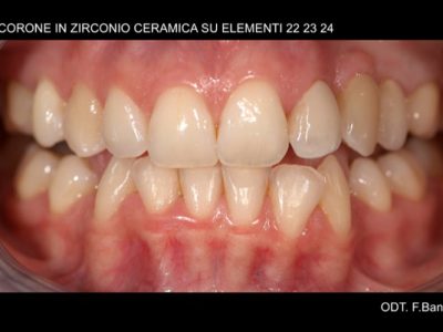 Caso 14 “corona in zirconio”