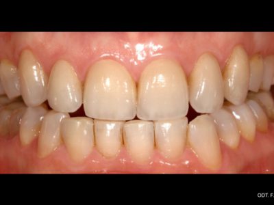 Caso 8 “faccette in ceramica”