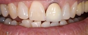 Caso 26 “Corona in zirconio ceramica Full”